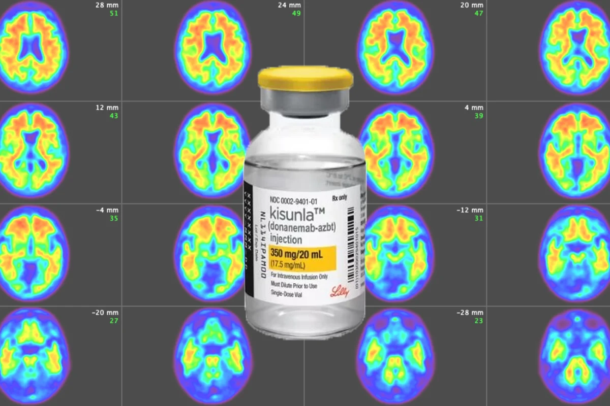 La FDA aprueba Donanemab: tratamiento del Alzheimer en fase inicial