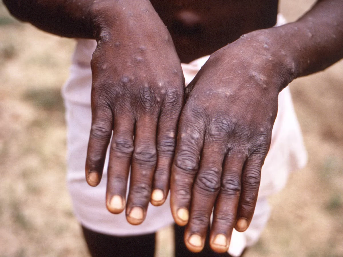 Virus Mpox: Qué es y por qué hay una alerta en América